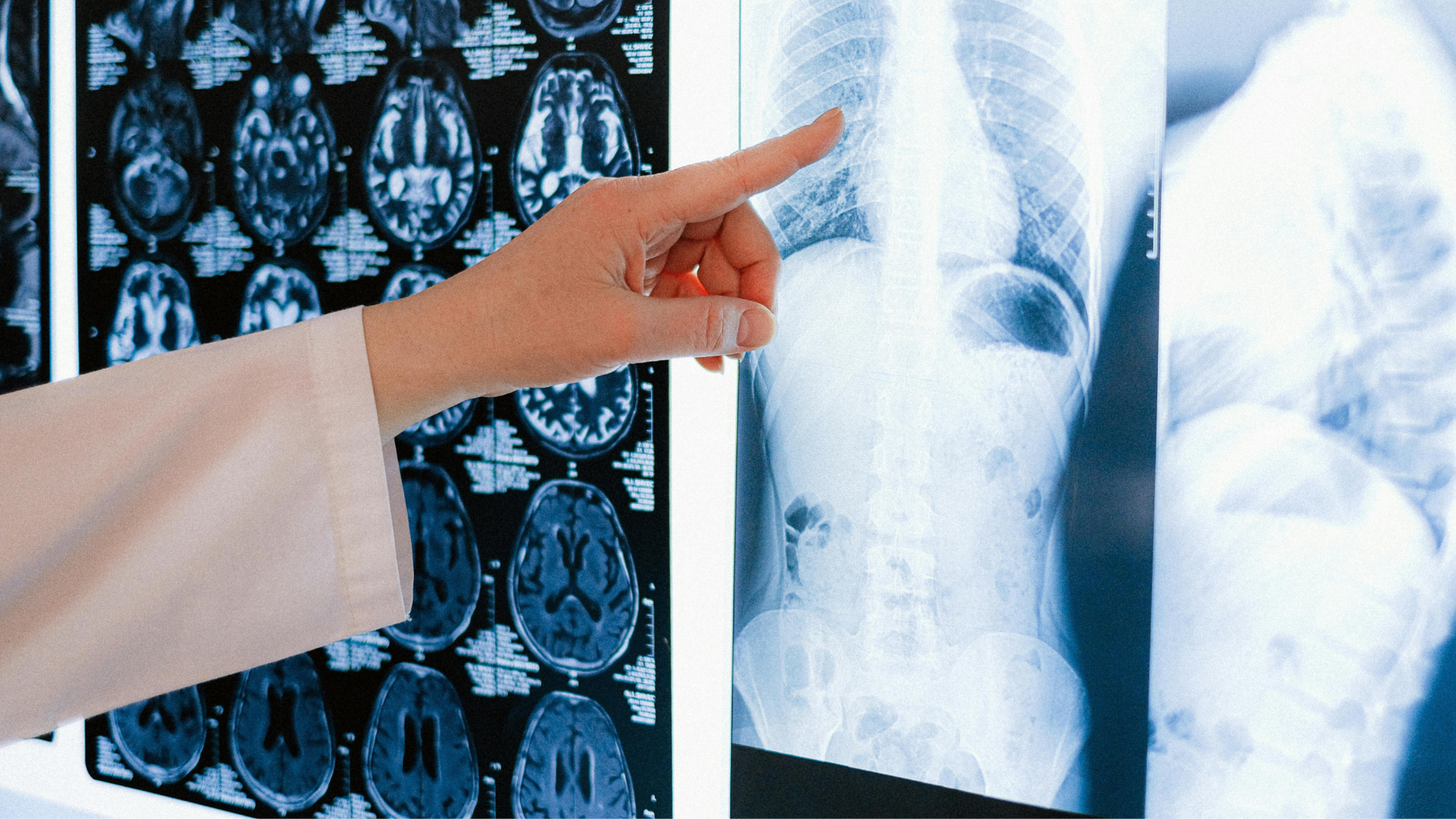 The AI Revolution in Radiology