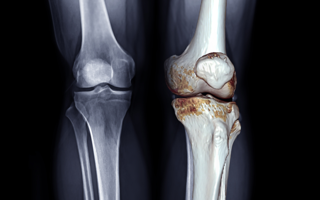 Using AI to Identify Early Onset of Osteoarthritis