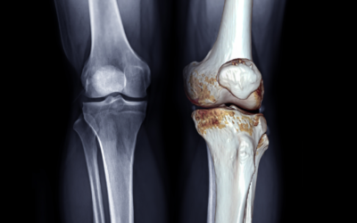 Using AI to Identify Early Onset of Osteoarthritis