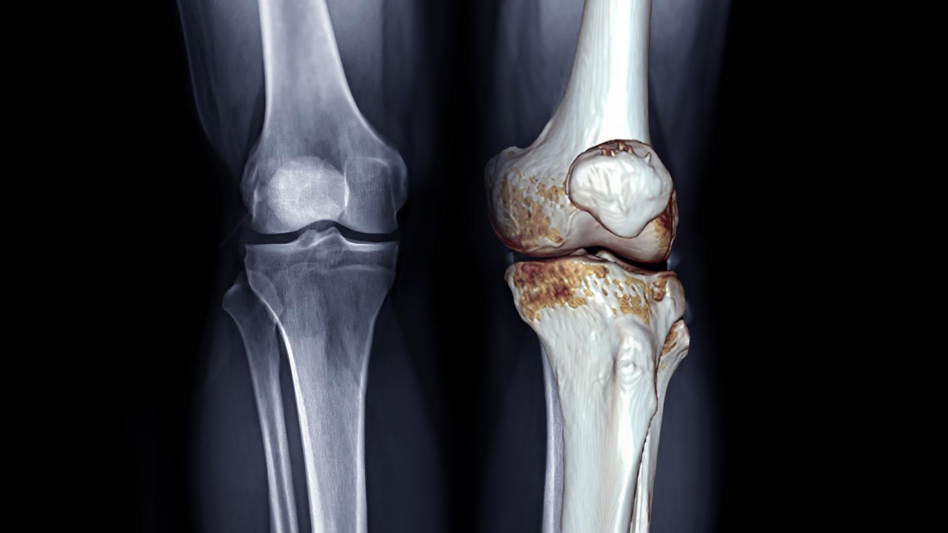 Using AI to Identify Early Onset of Osteoarthritis